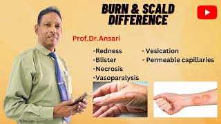 Difference between burn and scald  Redness  Blister  Vasoparalysis  Vesication  Necrosis [upl. by Chan]