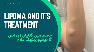 Lipoma  giltiyan  Homeo Treatment in Urdu Hindi  Dr M Salman [upl. by Werna]