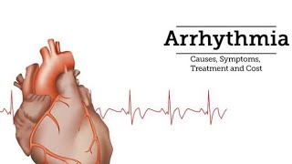 Supraventricular tachycardia SVT [upl. by Oderfodog]