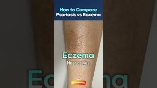 How to Compare Psoriasis and Eczema [upl. by Naitsirc]