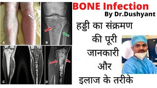 BONE Infection In Hindi  हड्डी का संक्रमण क्या होता हैपूरी जानकारी और इलाज के तरीकेDrDushyant [upl. by Names]