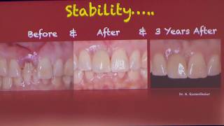 Clinical case with low insertion torque but high ISQ [upl. by Kalvin]