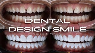 DENTAL DESIGN SMILE  I WENT TO MIAMI TO GET VENEERS  COMPOSITE VENEERS [upl. by Michaelina]