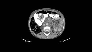 Linfadenite tuberculosa mesentérica e retroperitoneal [upl. by Henrietta283]