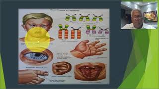 SINDROMES POR CROMOSOMOPATIAS NYE DE LOA AUTOSOMAS DR VIRGILIO PEREZ PARTE I [upl. by Rodablas]