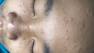 ACNE TREATMENT VU QUYNH MI  Blackheads Chin amp Nose Of Tweens 2024 EX [upl. by Ahsitniuq]