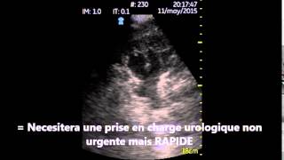 Uretero Hydronephrose moderee Echographe de poche Vscan utile en urologie aux urgences [upl. by Ecirtnas396]