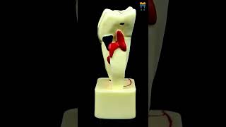 iDENTical 4X Pathologies of Tooth Model M4015  Dental Anatomy Learning Tool shorts shortsvideo [upl. by Ahrat]