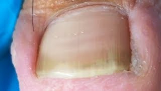 Wonderful ingrown toenail trimming Remove excess dead skin [upl. by Howlond]