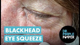 Blackhead Eye Squeeze [upl. by Malloch]