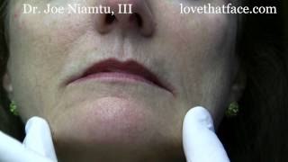 Botox Injection to DAO corner of mouth by Dr Joe Niamtu III [upl. by Sculley]