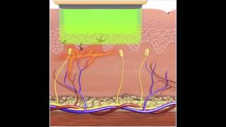 How IPL  Photorejuvenation works for Vascular Lesions [upl. by Maer82]