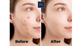 how to remove acne in photoshop  short photoshop tutorial [upl. by Sergent]