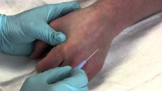 Intravenous Catheter Placement [upl. by Aihtak]