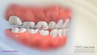 Anterior Crossbite Functional Shift [upl. by Andeee]