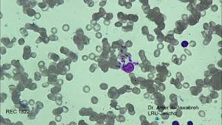 leishmania amastigotesSkin ulcer Giemsa Stain [upl. by Pease]