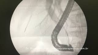 How to perform brush cytology by ERCP [upl. by Stent387]