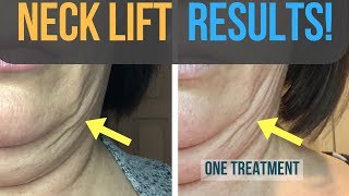 Results From My Fibroblast Plasma Neck Lift [upl. by Catie]