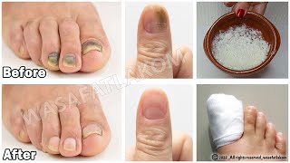 Do you suffer from nail fungus You have to do this  VERY IMPORTANT TIP [upl. by Nonnaihr]