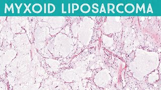 Myxoid liposarcoma high grade formerly round cell liposarcoma AIP France 2021 [upl. by Burd709]