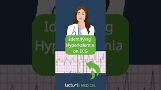 Key ECG Clues for Hyperkalemia 📊 [upl. by Etnomal995]