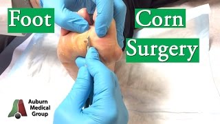 Foot Corn Surgery Treatment [upl. by Ahsitahs503]