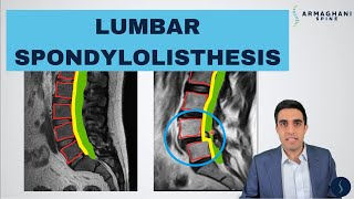 Lumbar Spondylolisthesis  Anatomy Symptoms Causes Treatments and more [upl. by Aday745]