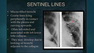 chest X ray what to look for part II [upl. by Lu]