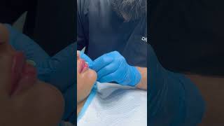 Lip Fillers Treatment [upl. by Nwadahs]