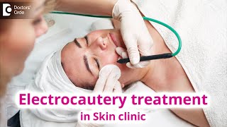 Use of Electrocautery Treatment in Skin Clinic  Electrocautery  Dr Rasya Dixit  Doctors Circle [upl. by Arvy]