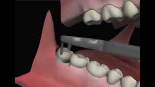 Third Molar Extraction Wisdom Teeth [upl. by Hadeehuat343]