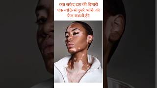 क्या सफ़ेद दाग़ की बिमारी एक व्यक्ति से दूसरे व्यक्ति को फैल सकती है vitiligo vitiligocure facts [upl. by Nabala]