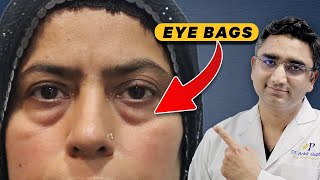 Lower Eyelid Surgery Before and After In Hindi  Eyelid Surgery Results Female Patient [upl. by Pail]