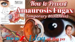 How to prevent Amaurosis Fugax or Temporary Blindness [upl. by Melvena697]