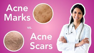 How to Treat Acne Marks vs Acne Scars [upl. by Disraeli]