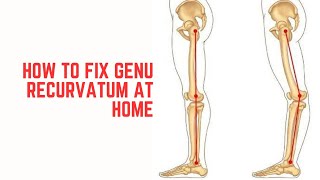 How to fix Genu RecurvatumHyperextended knee at home [upl. by Jet969]