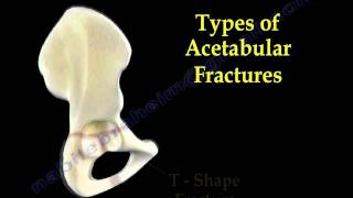 Acetabular Fractures  Everything You Need To Know  Dr Nabil Ebraheim [upl. by Anawqahs]