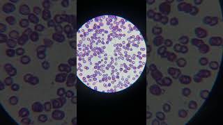 Microcytic hypochromic anemia  anemia  special smear  iron diffiency Anemia anemia under 🔬 [upl. by Yerffeg]