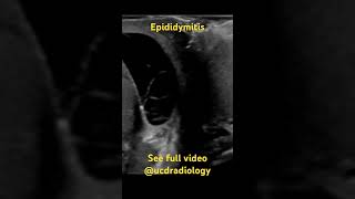 Epididymitis radiologist radiology ultrasound medicine medicalschool [upl. by Niklaus]