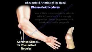 Rheumatoid Arthritis of the hand  Everything You Need To Know  Dr Nabil Ebraheim [upl. by Marcella]