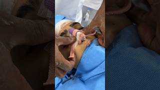 Nose Packing and Nasal splint after rhinoplasty [upl. by Croft]