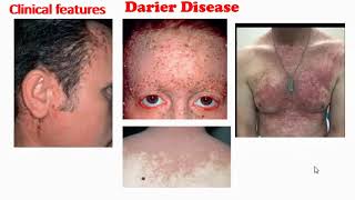 Darier Disease [upl. by Sew]