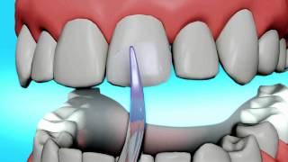 Dental Bonding Video  Tooth Bonding [upl. by Troc]