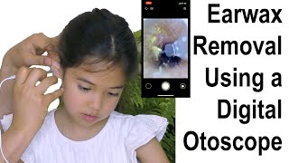 Earwax Removal Using a Digital Otoscope at Home [upl. by Einnoc]