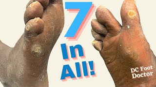 7 In All Removal of Multiple Porokeratoses of the Feet [upl. by Medeah327]