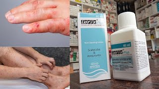 স্ক্যাবিস ও চর্মরোগের চিকিৎসা  Lorix Plus Lotion ব্যবহার করার নিয়ম dermatology [upl. by Ambrosius499]