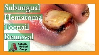 Subungual Hematoma Blood Clot Under Nail Removal  Auburn Medical Group [upl. by Ajet]