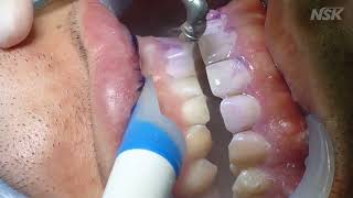 NSK Pero Mate Removing plaque [upl. by Nichole]