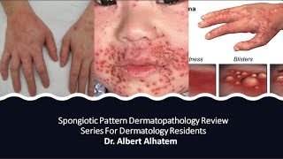 Dermatopathology Lesson 1 Spongiotic Dermatitis Tissue Reaction Patterns [upl. by Ullyot]