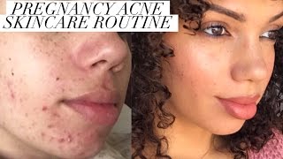 PREGNANCY ACNE  HOW TO CONTROL BAD BREAKOUTS [upl. by Rosa]